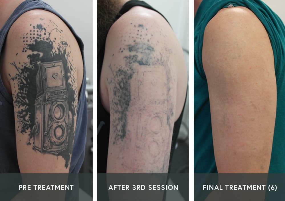 How Many Treatment Sessions Are Required To Remove A Tattoo?